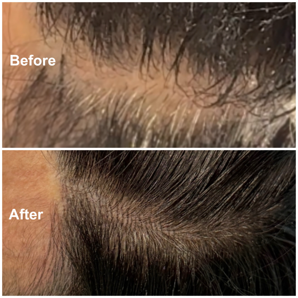 Micro Dot Or Hairline at Jacklyn Beauty and Spa in Lakeland, FL
