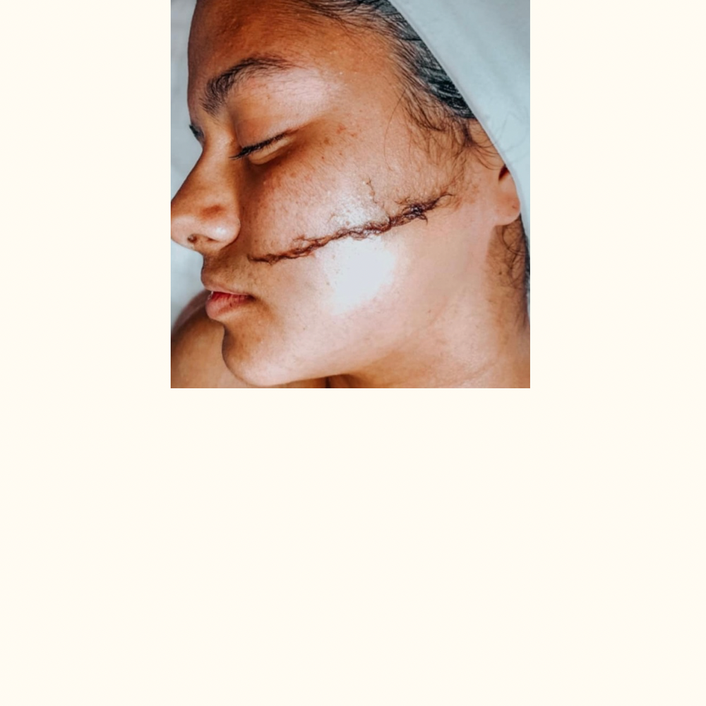 Dermaplaning