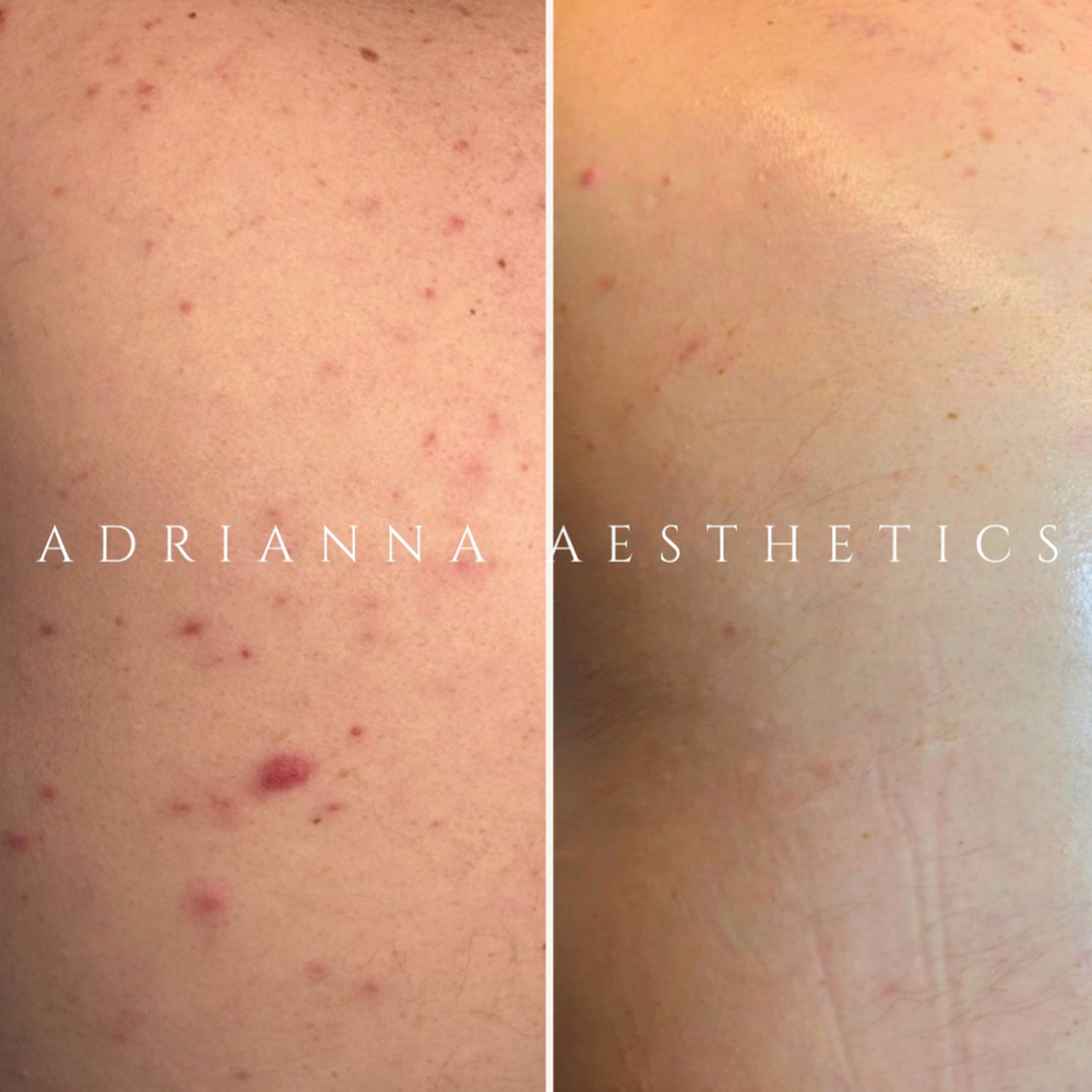 Corrective Back Treatment ⭐️