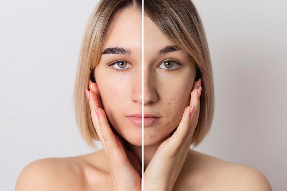 Pore Control