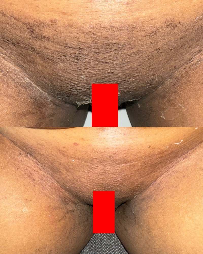 Vaginal Intimate Bleaching