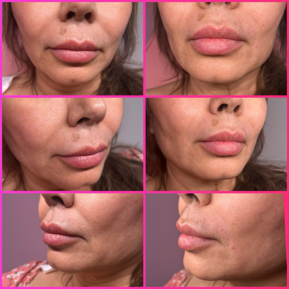 Nasolabial at Belleza Divina Aesthetics in Guymon, OK