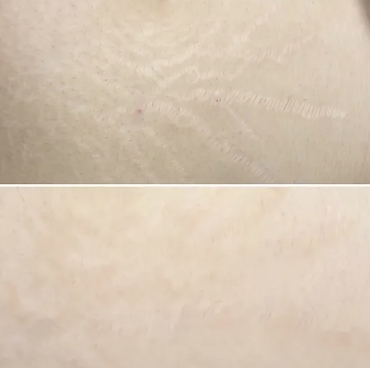 Stretch mark removal package 3 apts