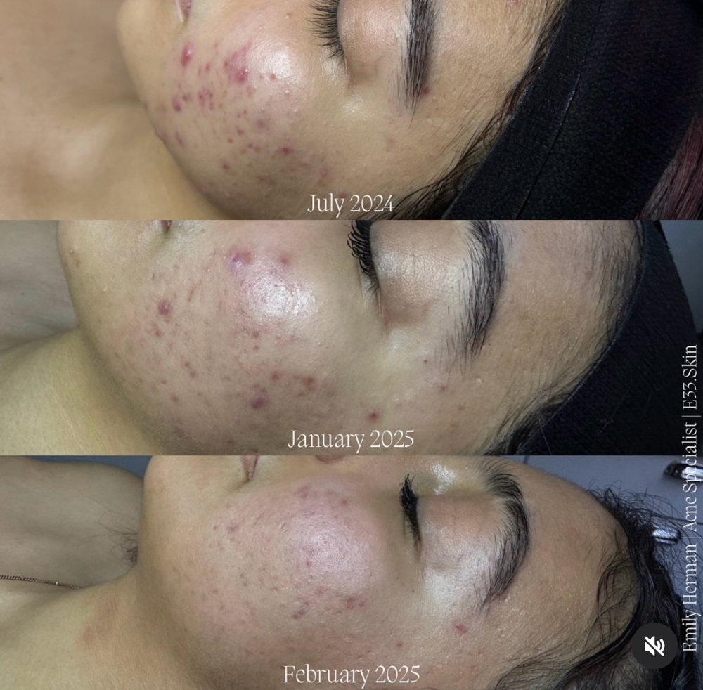 The Clarity Protocol at E33 Esthetics in Williamsport, PA