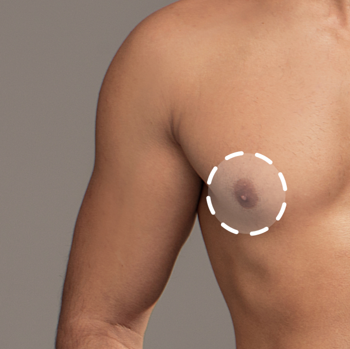 Areolas