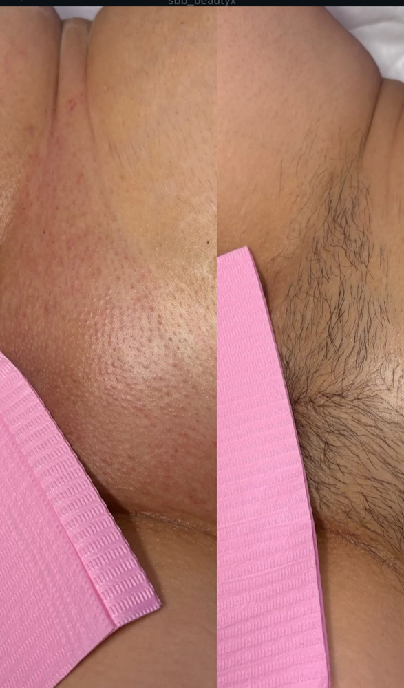 New Client Brazlian Wax at SBB Beauty in Union, NJ