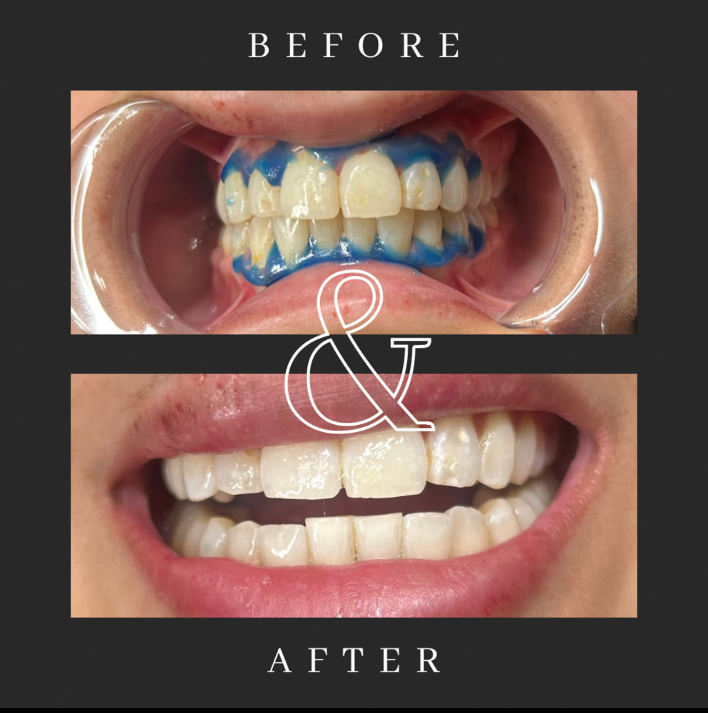 90 min Teeth Whitening at Classy Kelsey in San Antonio, TX
