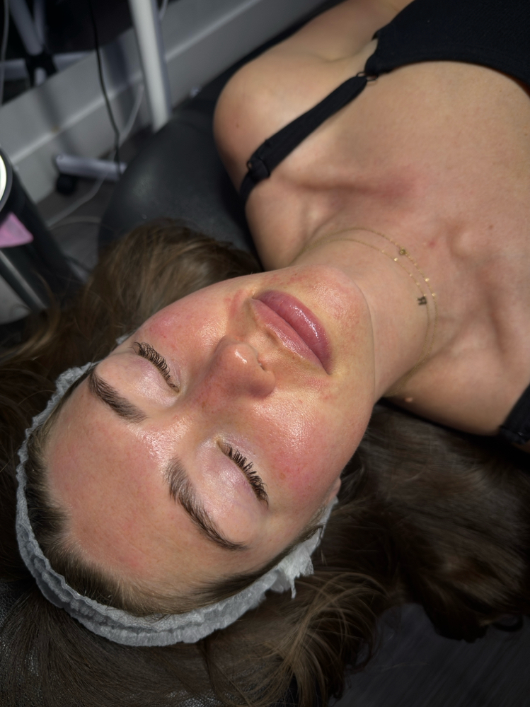 Hydrafacial