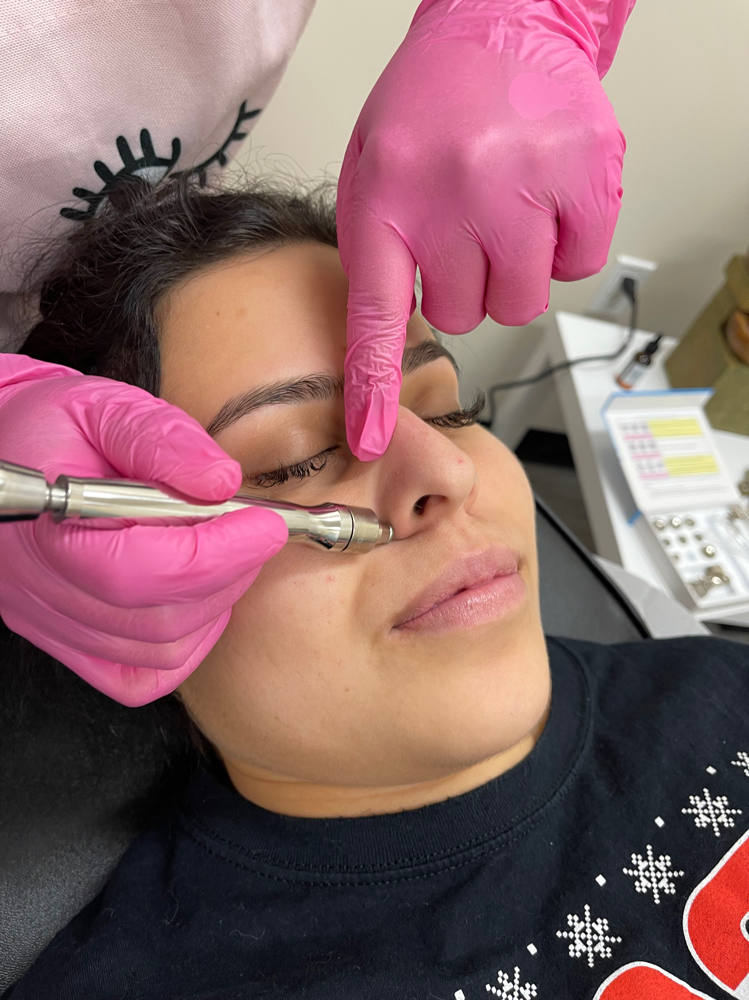 ADD-ON: Microdermabrasion