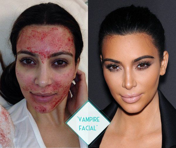 Vampire Facial PRP