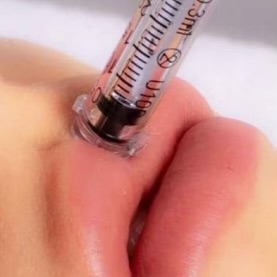 Hyaluron Pen Fillers at Ahedo Beauty Studio in Brownsville, TX