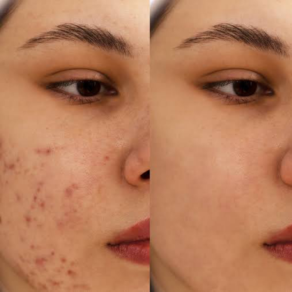 Acne Relief at Endless Skincare in Long Beach, CA
