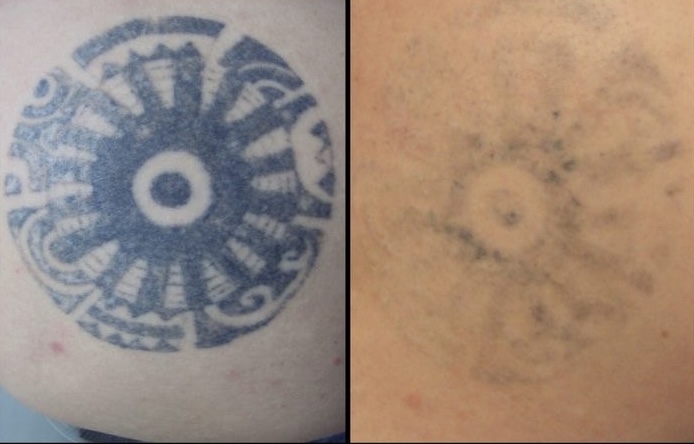 Remocion De Tatuajes