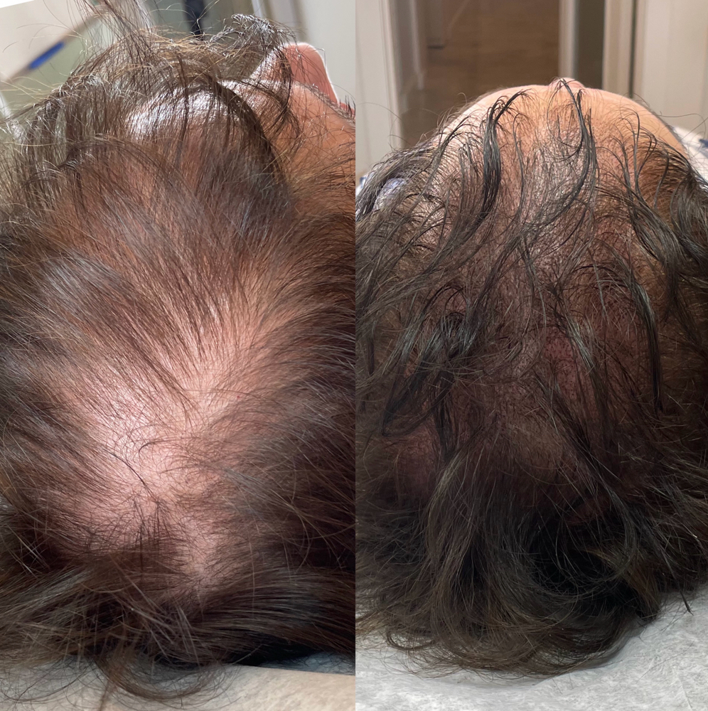 Scalp Micropigmentation at The Inked Mellen in Peabody, MA