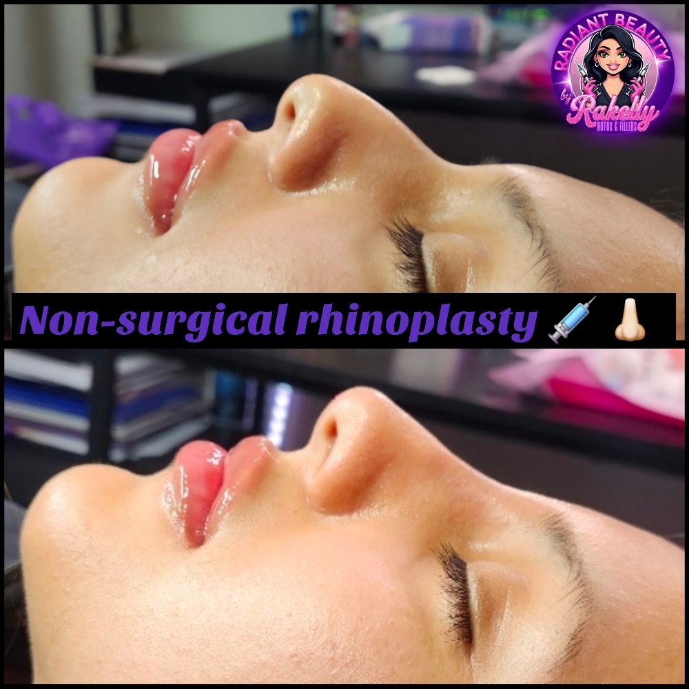 Nose Countour/Slim/Lift With Botox at Radiant Beauty By Rakelly LLC in Fort Worth, TX