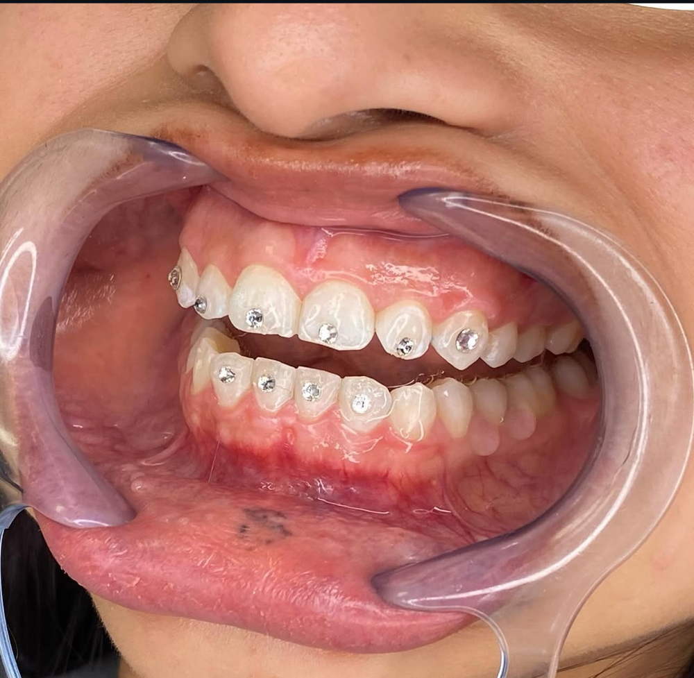 TOOTH GEMS
