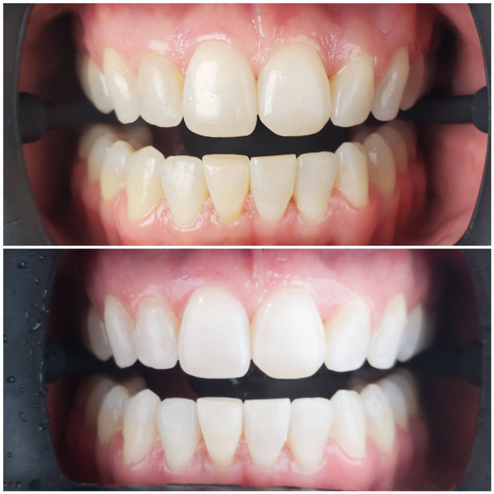 Teeth Whitening at Touch of Beauty in Stuart, FL