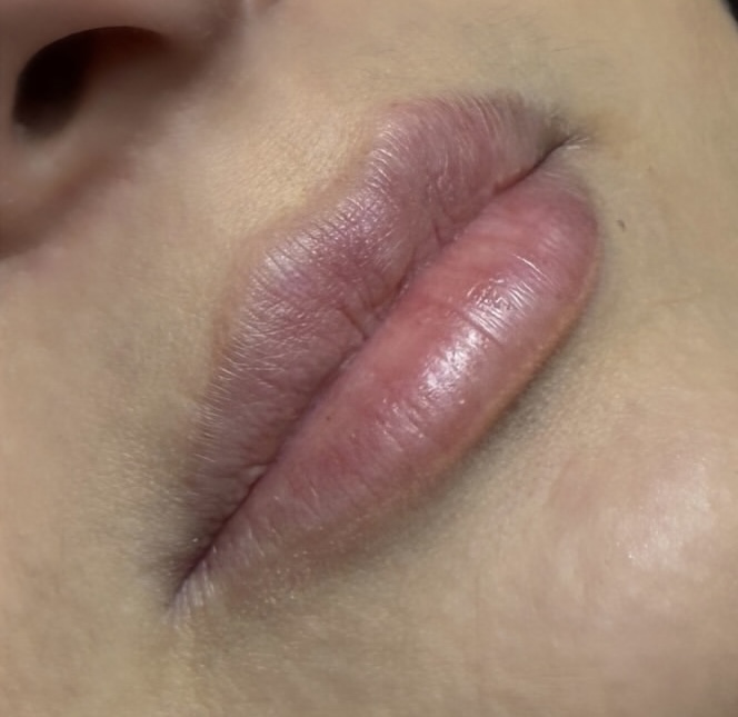 Lip Filler HyaPen