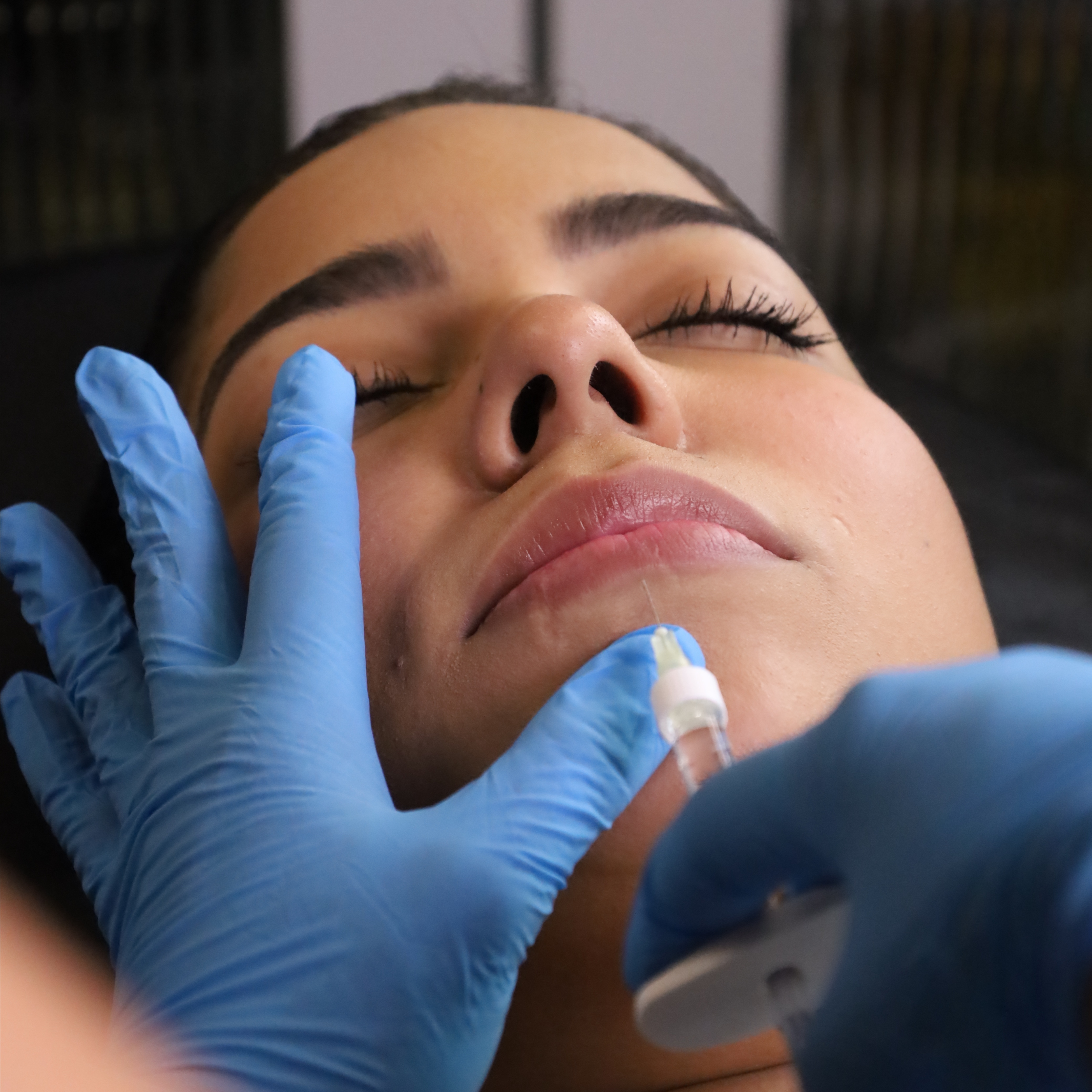 Rellenos Faciales (Derma Fillers) at 180º Med Spa in Dallas, TX