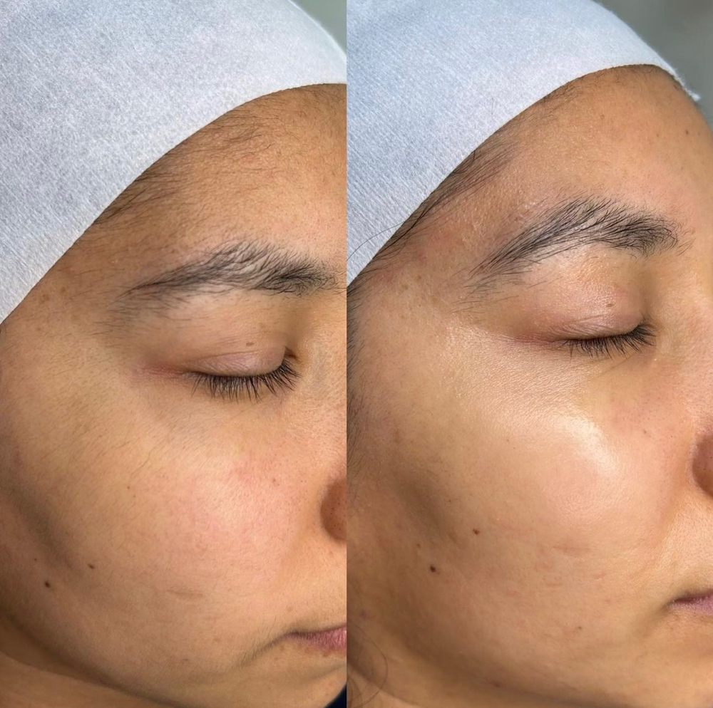 Express Dermaplane