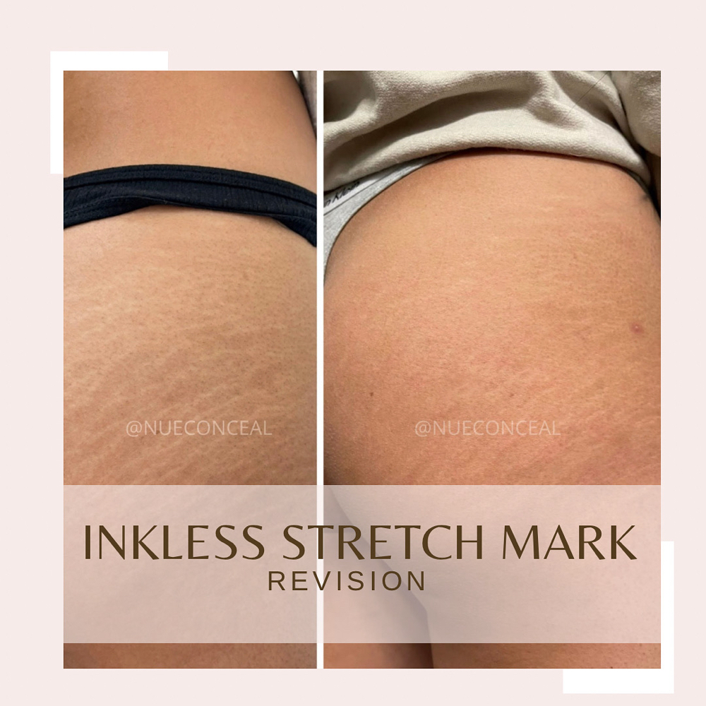 Inkless Stretch Mark Revision