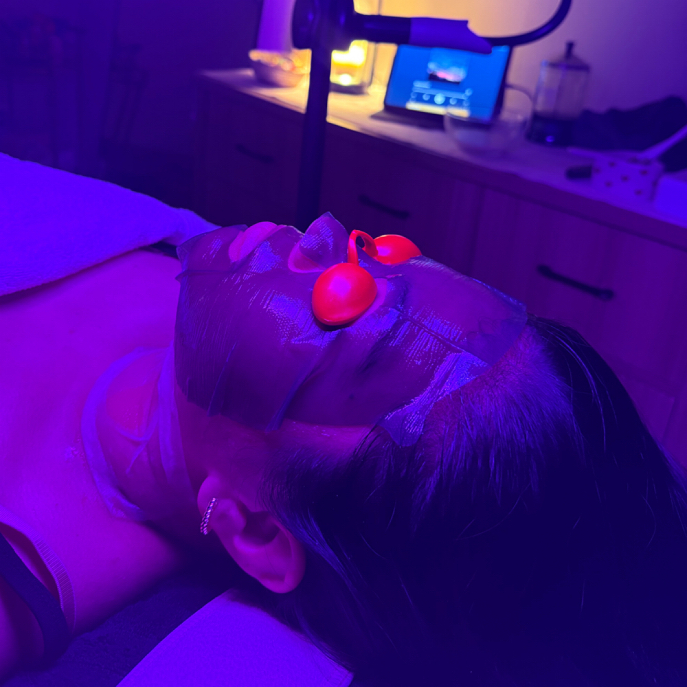Microneedling Face+Neck at Bonita Esthetics in St Louis Park, MN