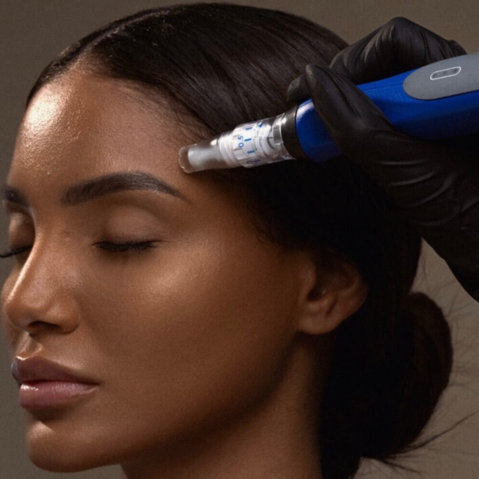 Microneedling w/PDRN at The Allure Aesthetic in Columbia, MD