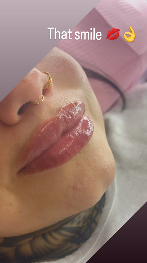 💋Refill 1/2 Syringe 💋