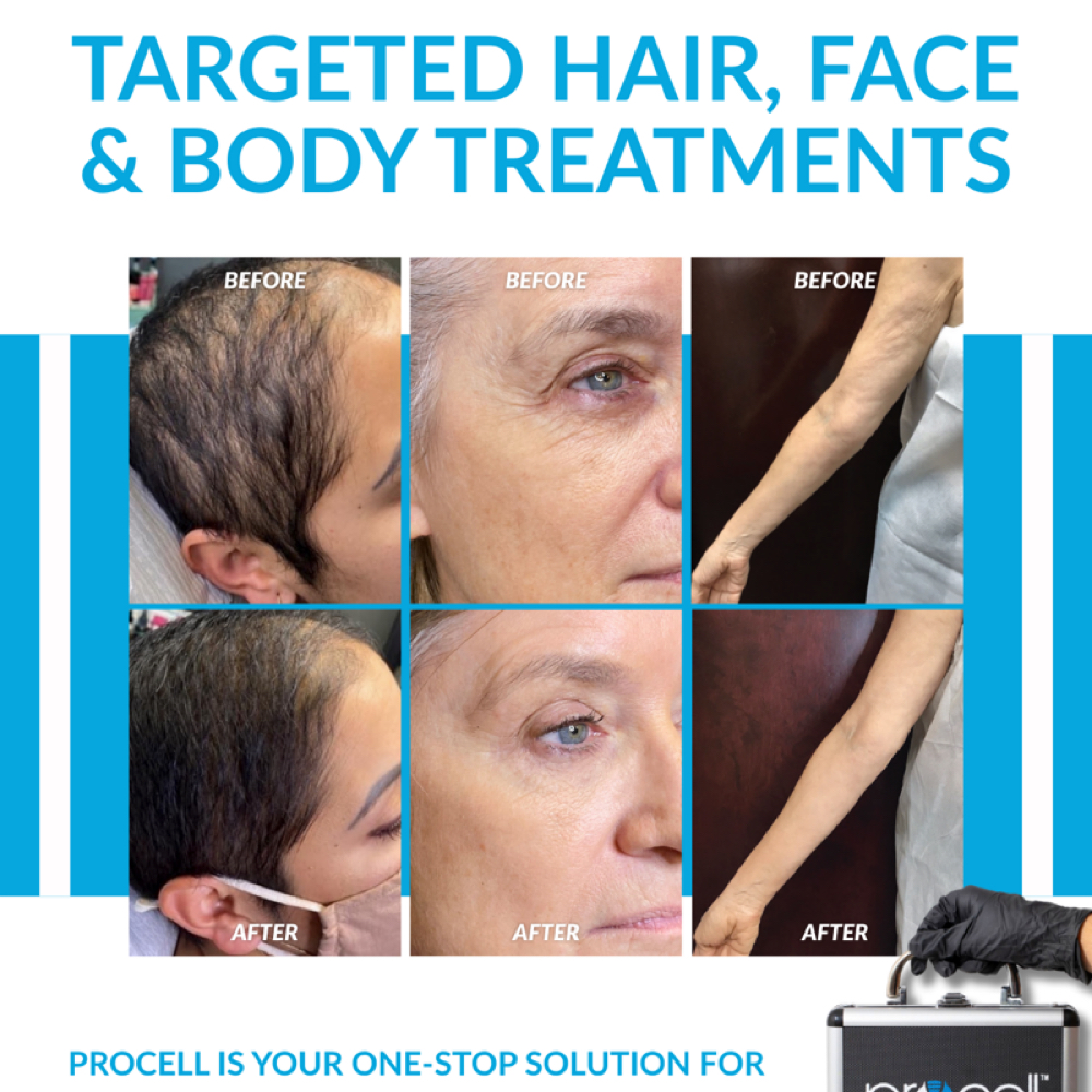 Microchanneling with Procell MD at Skin Matters in Hilton Head Island, SC