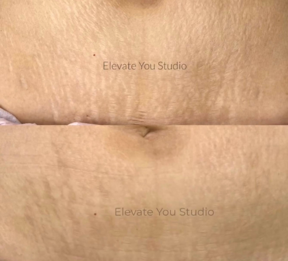 Stretchmark Camouflage *MODEL PRICE