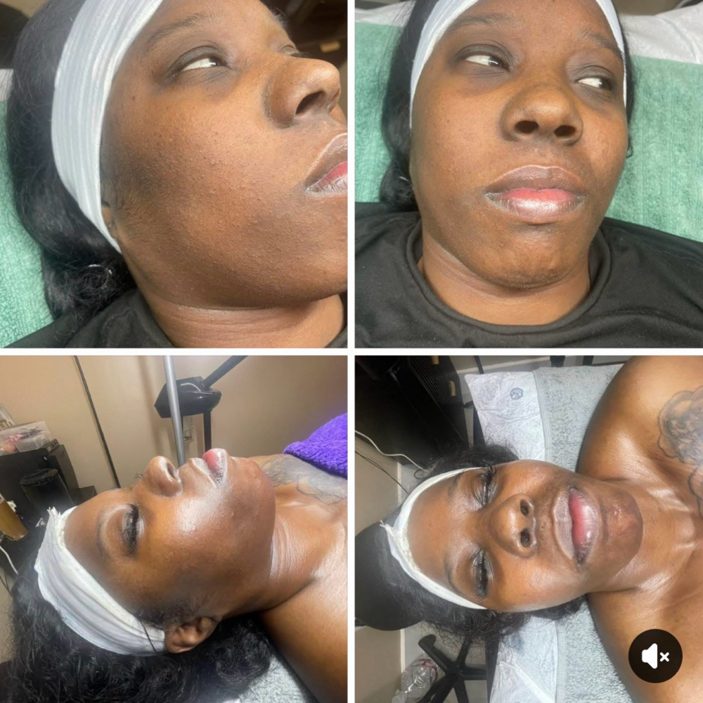 Reset Facial at All Set Wax Spa in Miami Gardens, FL