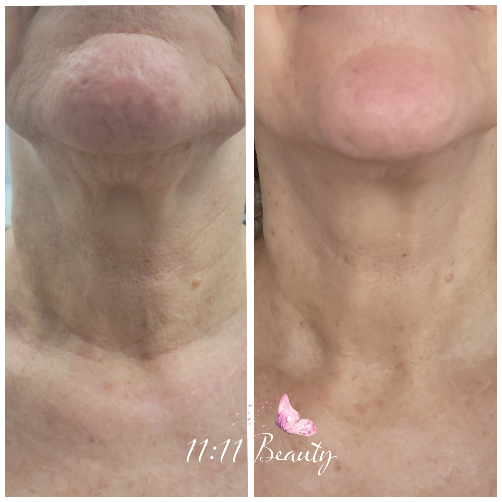 Jet Plasma For Neck Package Of 6