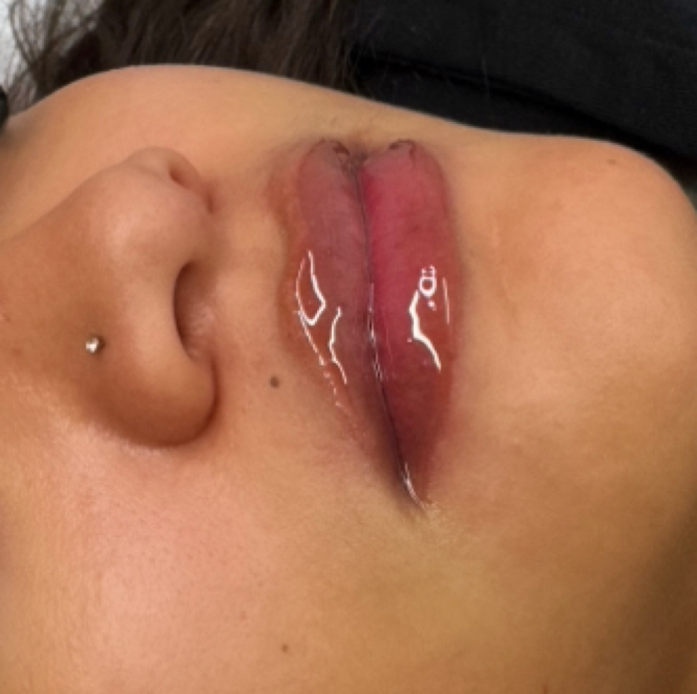 Lip Filler - 1mL at Honeydip Glam in Fairfax, VA