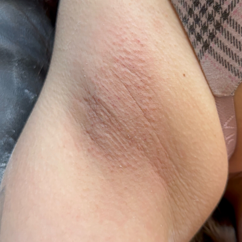 Underarm Sugaring at Majestic Esthetics in Vacaville, CA