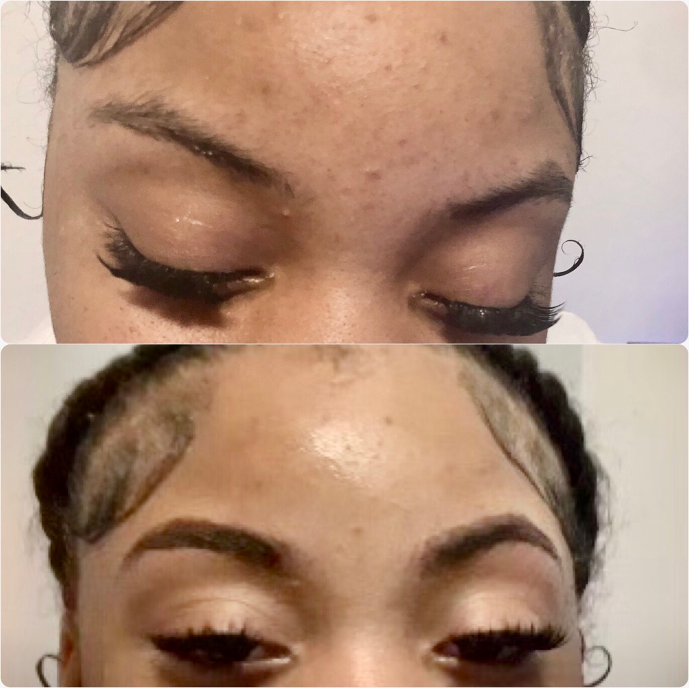 Brow Rehab