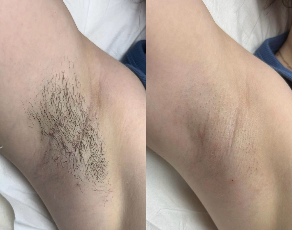 UNDERARM WAX