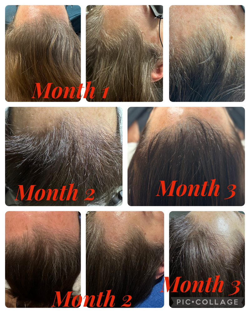 Keravive Partial Scalp