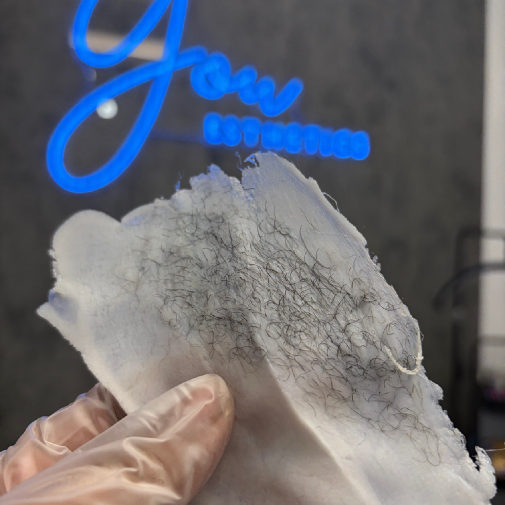 Stomach Strip at You Esthetics in Salem, MA