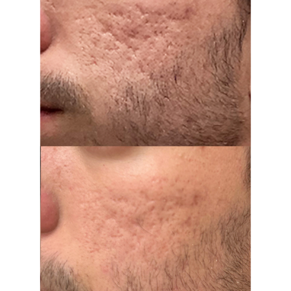 Scar Treatments at Meraki Artistry in Greenwood, IN