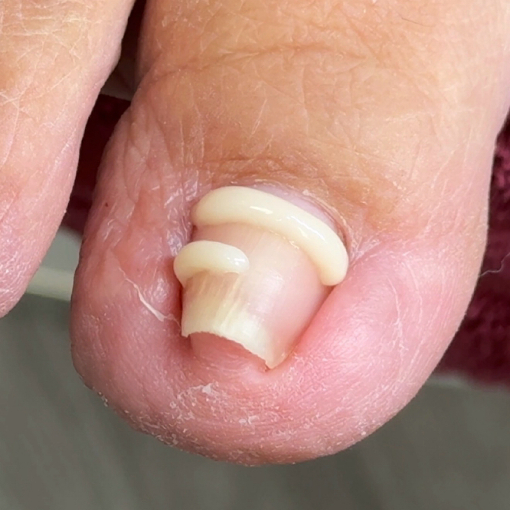 Onyfix Nail Correction at Marnicured Nail Salon in Plymouth, MN