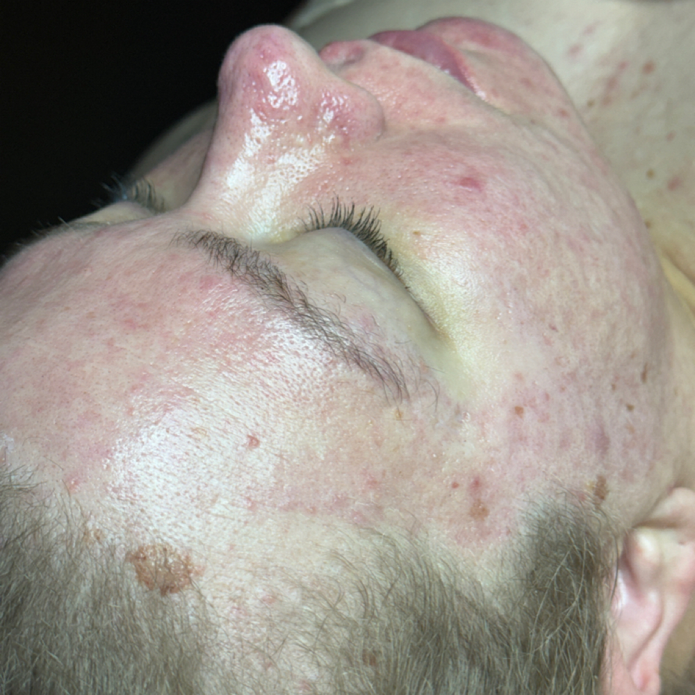 Barrier Reset Facial at Skin Refinery in Ozark, MO