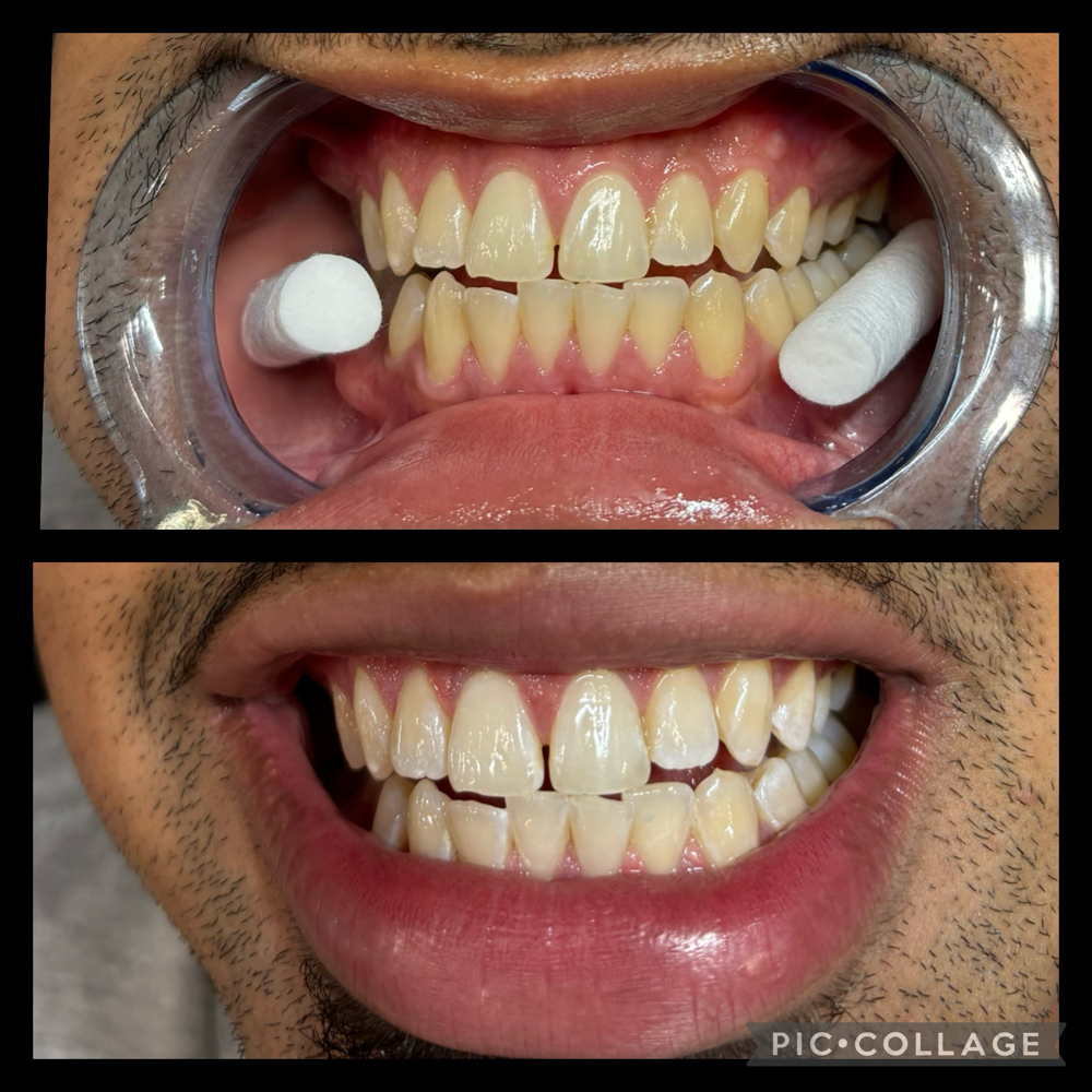 Teeth Whitening