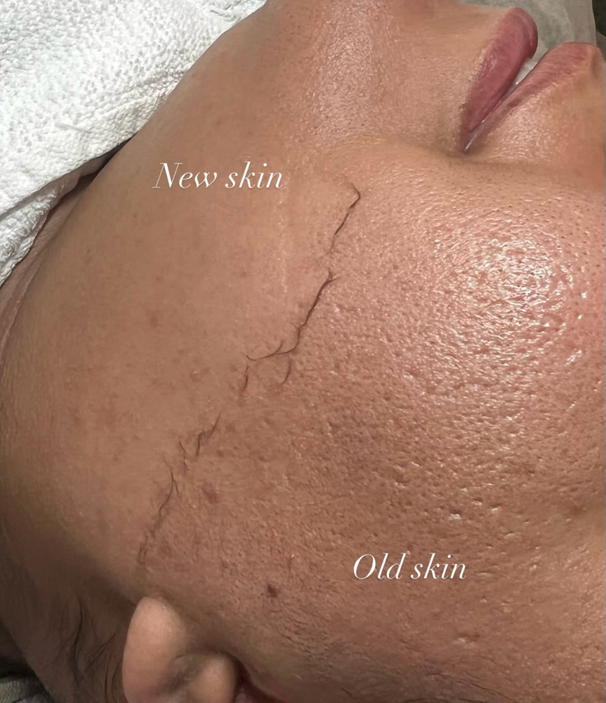 Tier 1 Facial