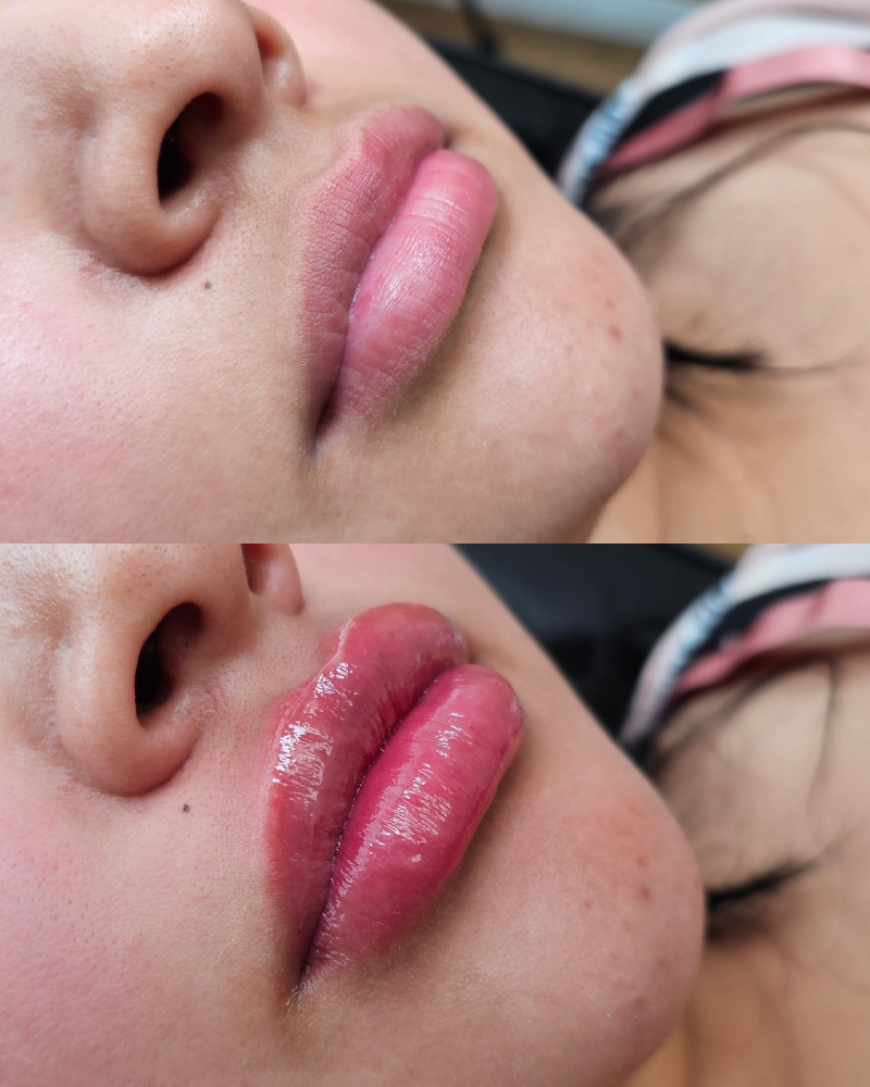 HA Lip Fillers (New Client)