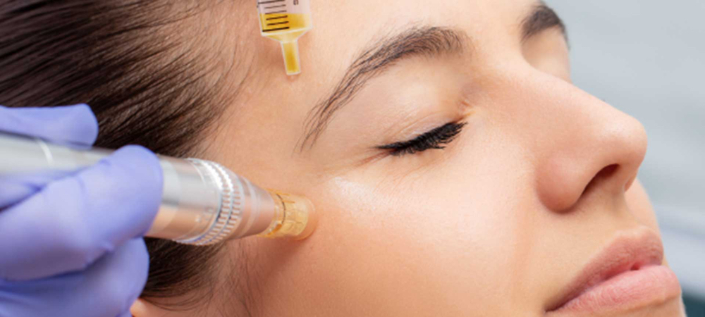 Exosomes + Microneedling