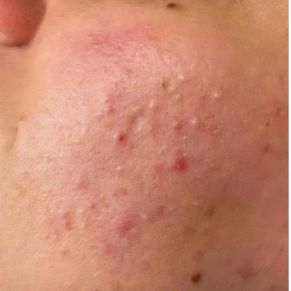 Acne/Oily Skin Facial at Crystalyn Couture 👑 Salon & Spa in Surprise, AZ