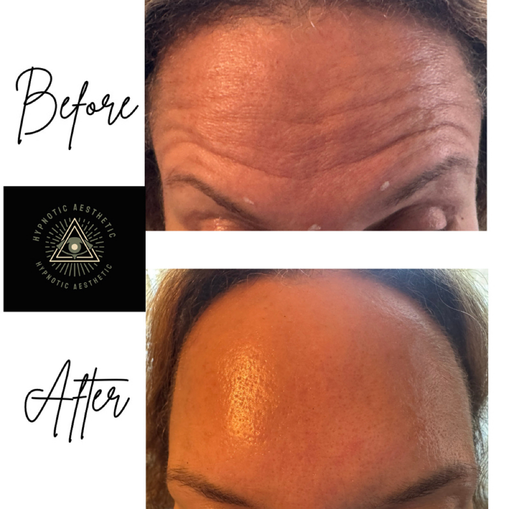 Frontalis at Hypnotic Aesthetic in Lavon, TX