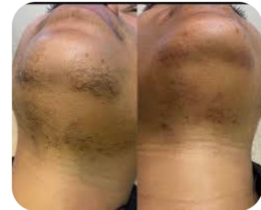 Chin Wax