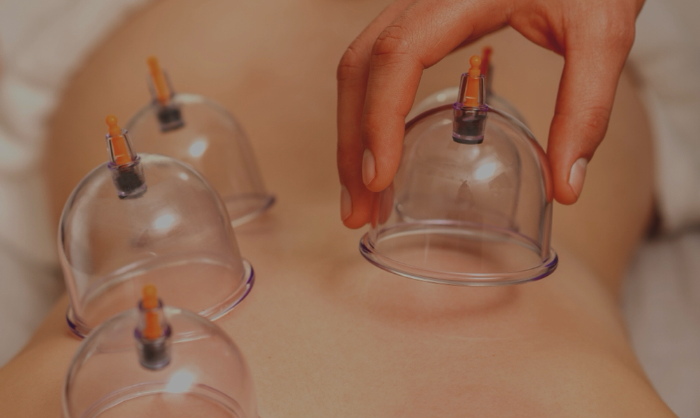 Therapeutic Cupping