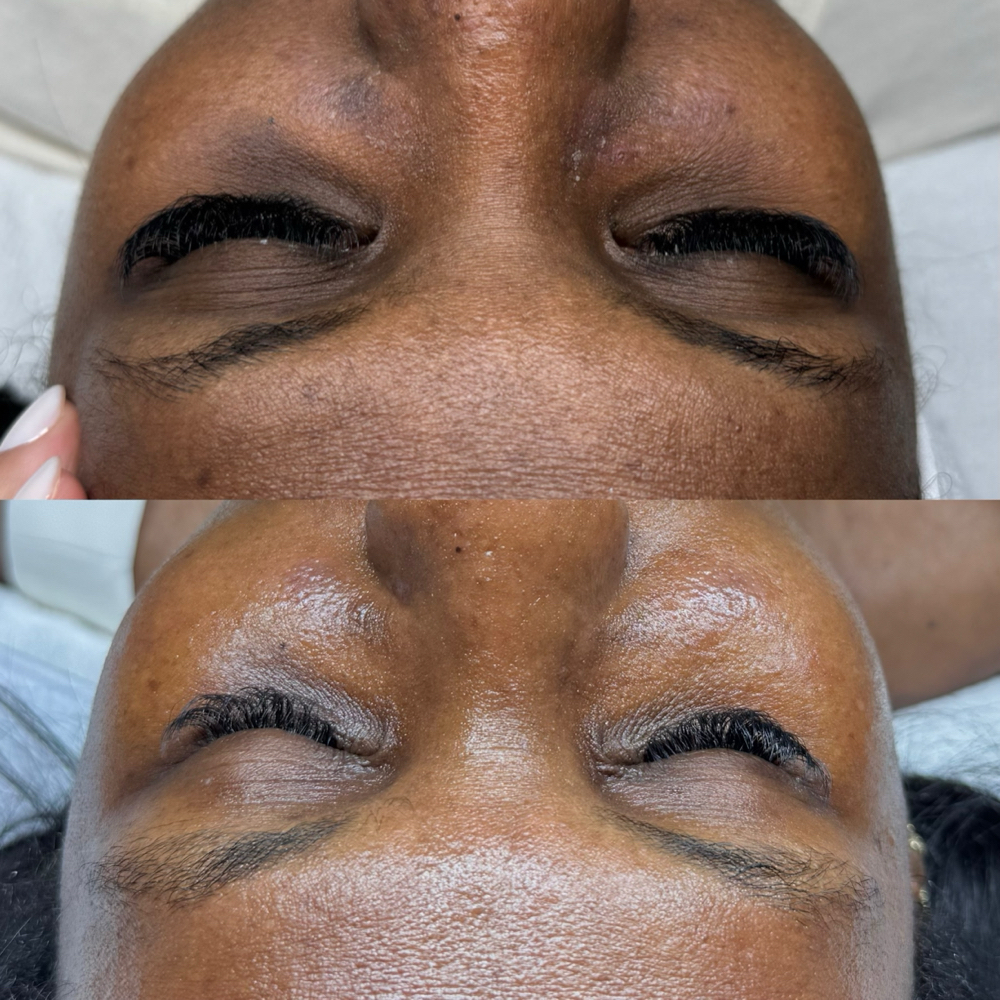 Melasma & Pigmentation Program at Taiane Alvarenga Concept in Woburn, MA